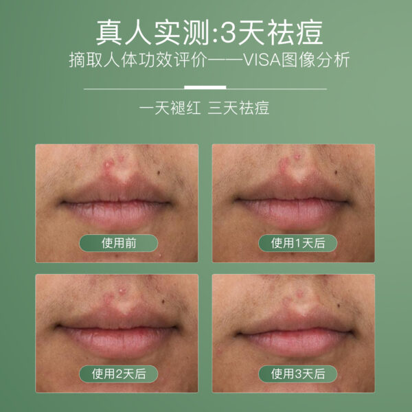 6 凈痘清顏舒緩精華液